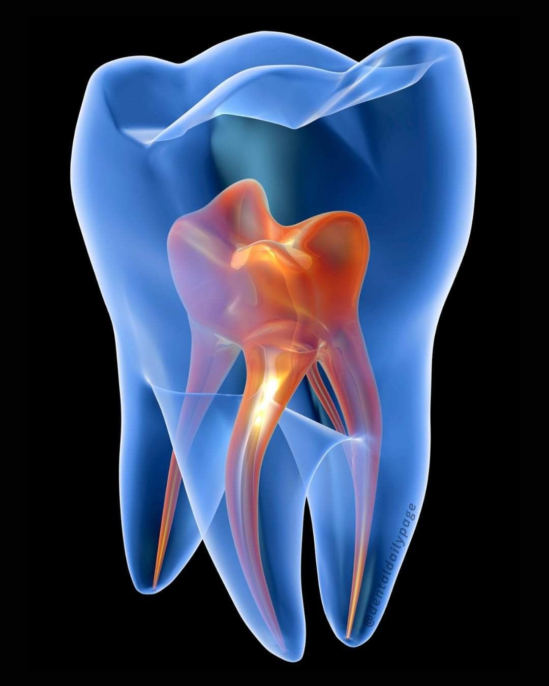 Root Canal 2