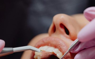 Chipped Tooth Treatment: Steps to Take and Repair Options