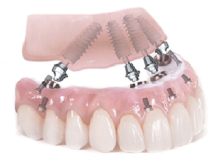 edentulous (1)